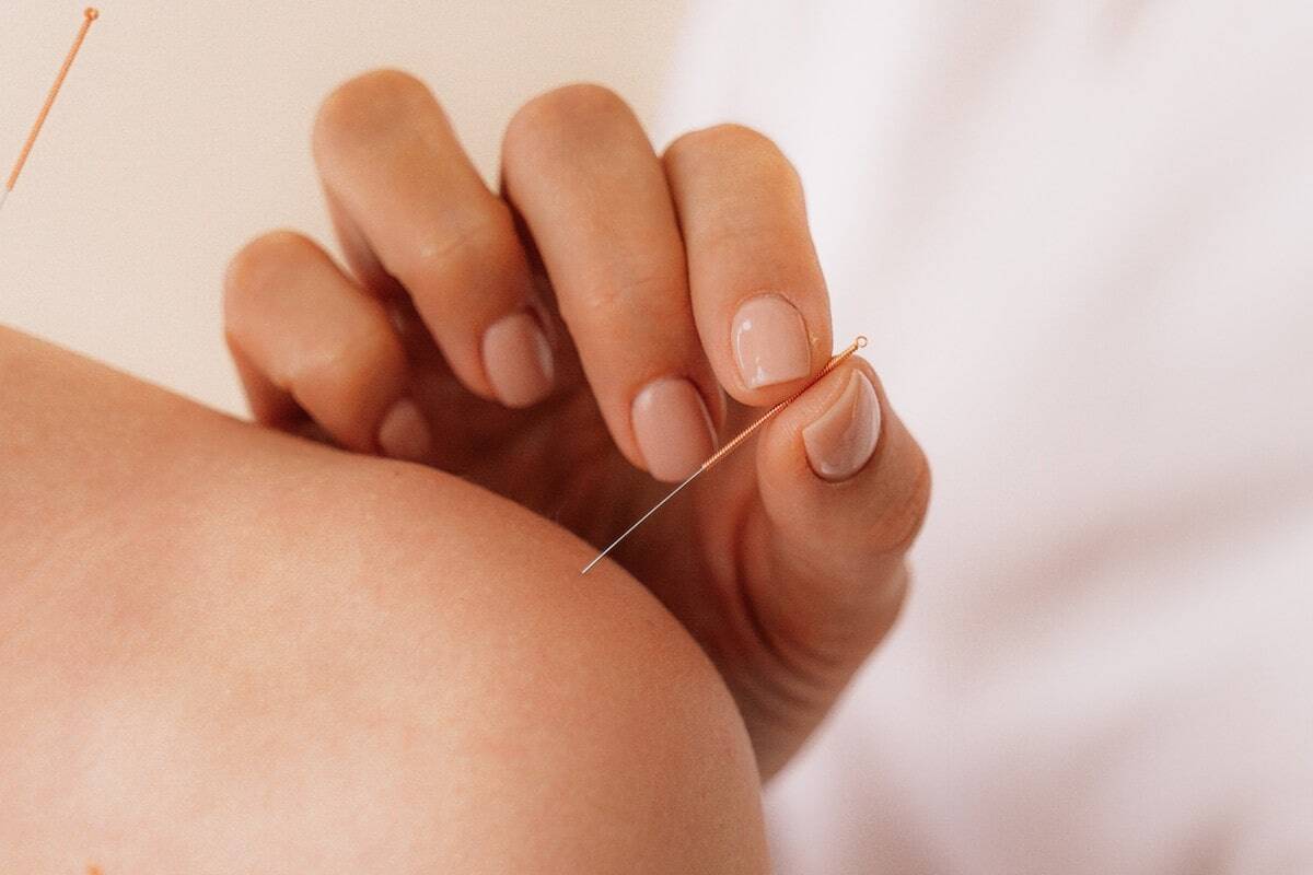 dry-needling-for-patients-afraid-of-needles